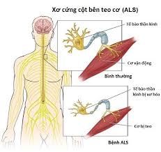 Bệnh xơ cứng teo cơ bên (ALS), bệnh thần kinh vận động (MND)