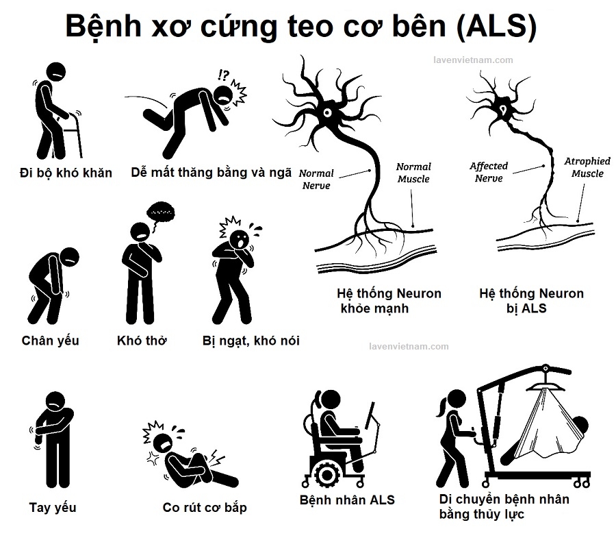 Biểu hiện củaBệnh xơ cứng teo cơ bên (ALS)