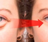 Cách làm giảm bọng mắt và quầng thâm mí mắt hiệu quả